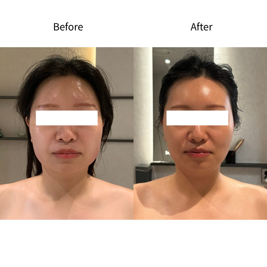 하악축소 사각턱 Before & After